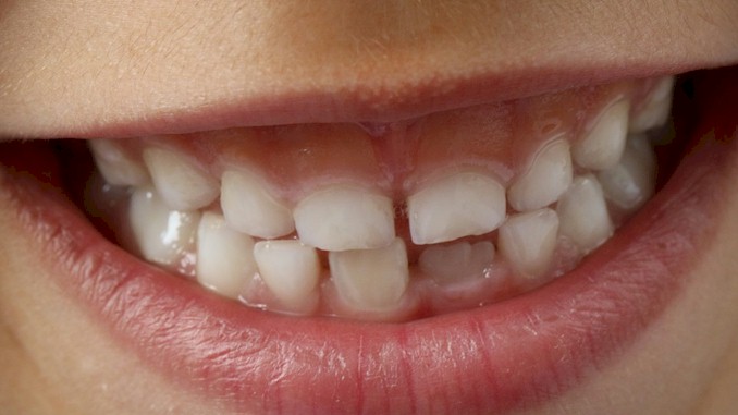 7至12歲孩子牙齒保健方法